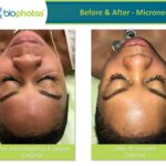 Before-After Microneedling AA Female